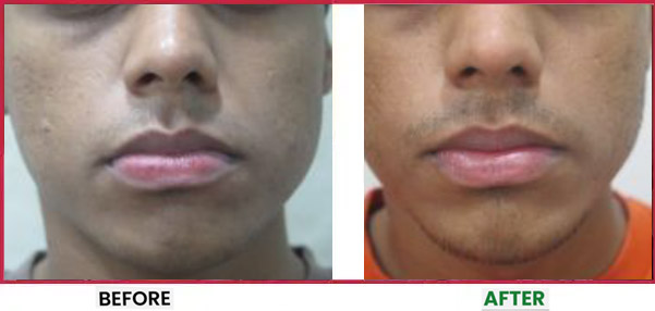 Acne Scar Treatment Before & After 8