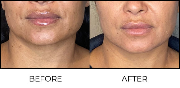 Skin polishing + whitening Before & After 8