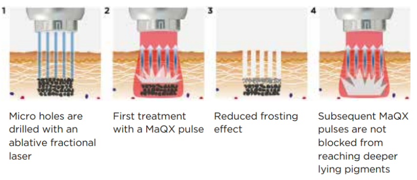 Tattoo Removal Treatment