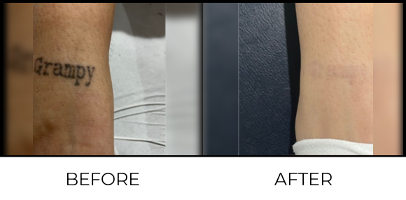 Tattoo Removal Before & After 1