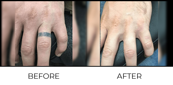 Tattoo Removal Before & After 2