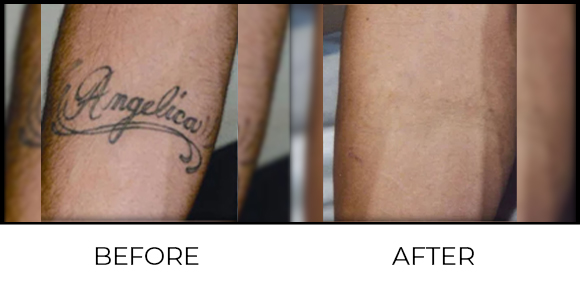 Tattoo Removal Before & After 3