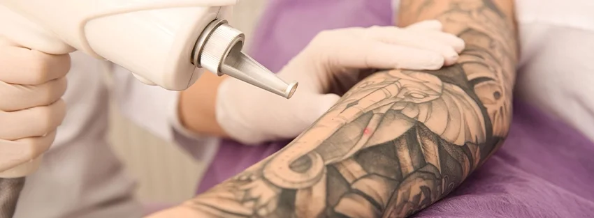 Tattoo Removal