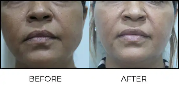 Threads Before & After 1