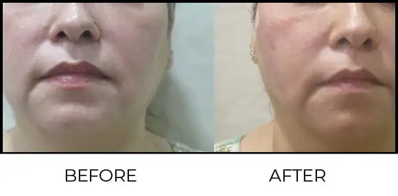 Threads Before & After 2