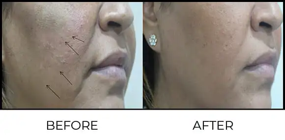 Threads Before & After 3
