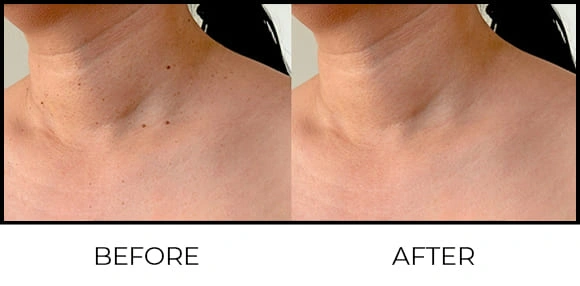 Wart Removal Before & After 2