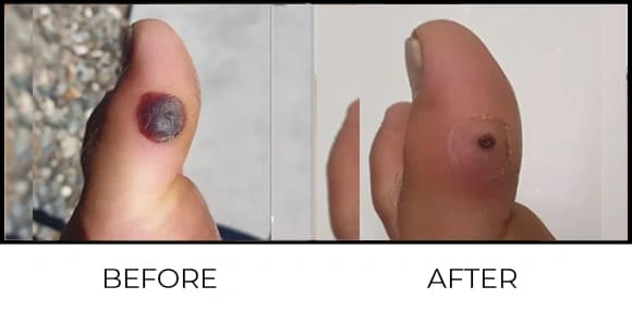 Wart Removal Before & After 1