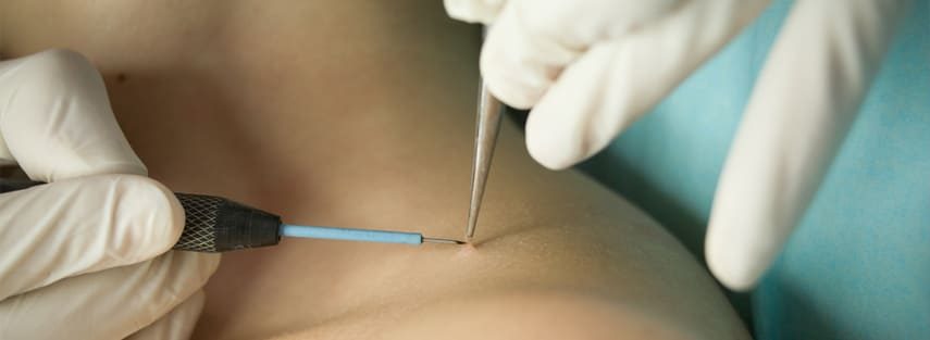 Wart Removal Treatment