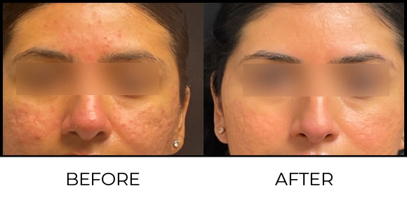 Yellow Peel® Before & After 6