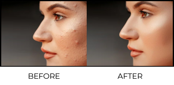 Yellow Peel® Before & After 7