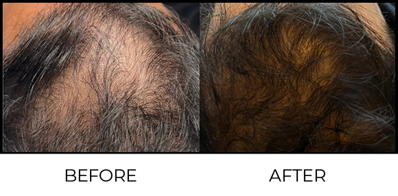 Dermapen Before & After 1