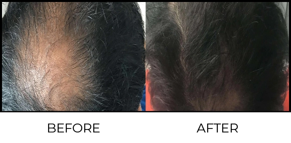 Dermapen Before & After 2