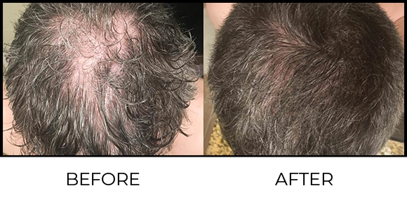 Dermapen Before & After 3