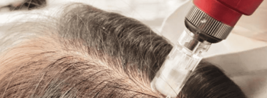 Dermapen at Skuccii Supercliniq