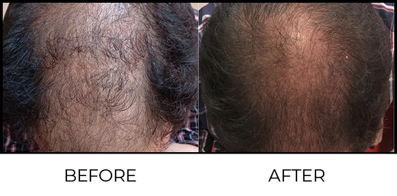 Dermaroller Before & After 1