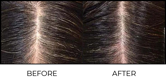 Dermaroller Before & After 2