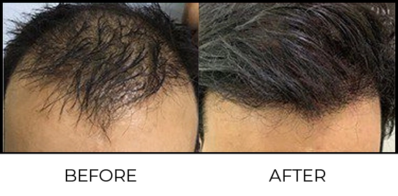Dermaroller Before & After 3