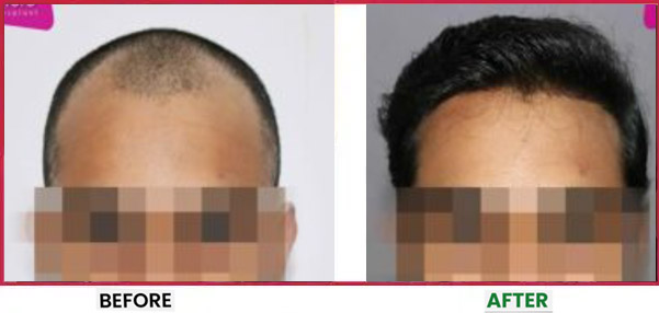 Hair Transplant in Mumbai Before & After 3
