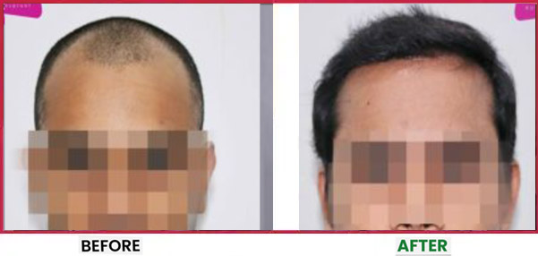 Hair Transplant in Mumbai Before & After 4