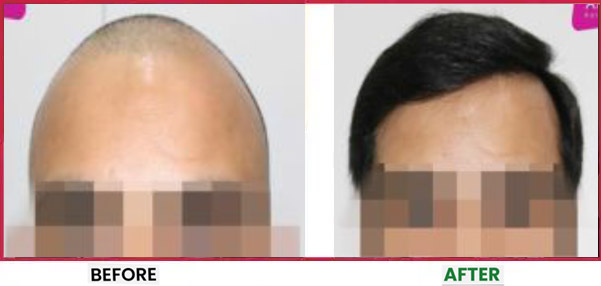 Hair Transplant in Mumbai Before & After 5