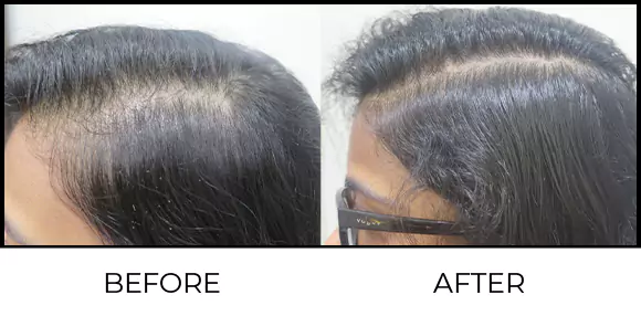 Hair Consultation & Trichology Before & After 1