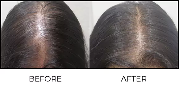 Hair Consultation & Trichology Before & After 2