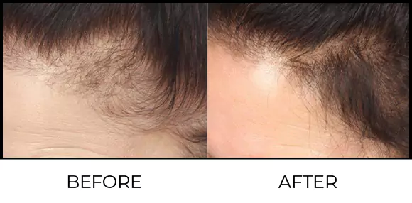 Hair Consultation & Trichology Before & After 3