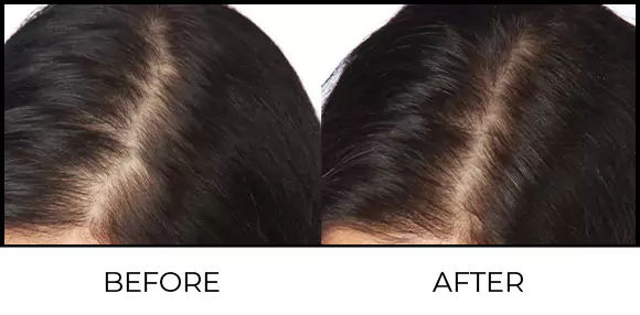 Hair Growth Lasers Before & After 1