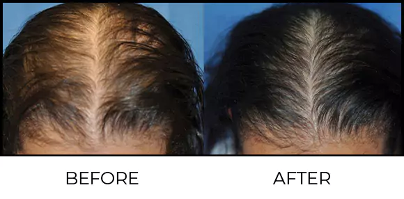 Hair Growth Lasers Before & After 2