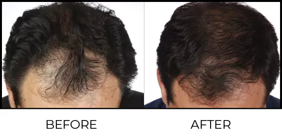 Hair Growth Lasers Before & After 3