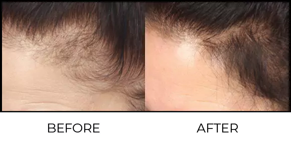 Hair Growth Lasers Before & After 4