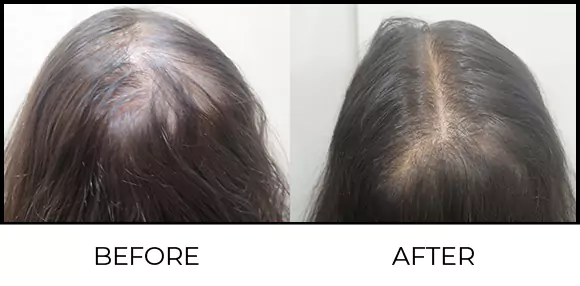 Hair Regrowth Treatment Before & After 1