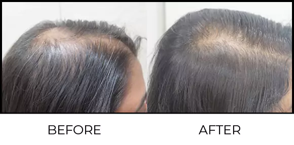 Hair Regrowth Treatment Before & After 2