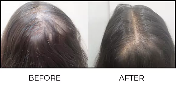Hair Regrowth Treatment Before & After 3