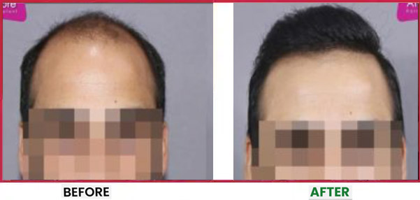 Mega Hair Transplant Before & After 2