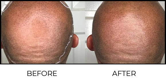 Scalp Micro Pigmentation Before & After 1