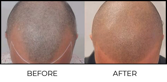 Scalp Micro Pigmentation Before & After 2