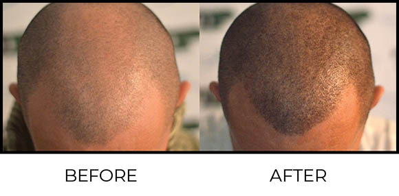 Scalp Micro Pigmentation Before & After 3