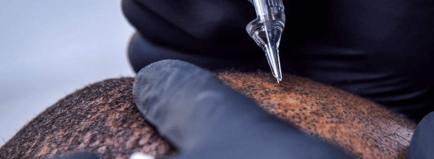 Scalp Micro Pigmentation at Skuccii Supercliniq