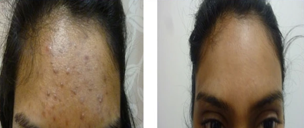 Acne Treatment Before & After