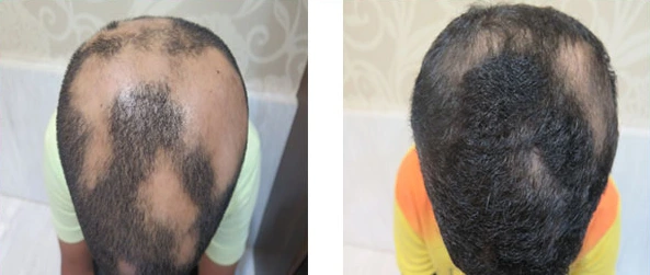 Alopecia Treatment Before & After