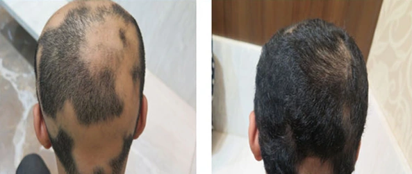 Alopecia Treatment Before & After