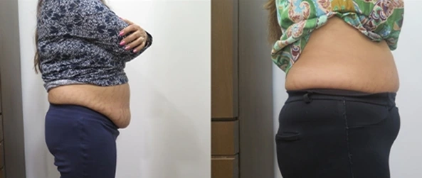 CoolSculpting Before & After