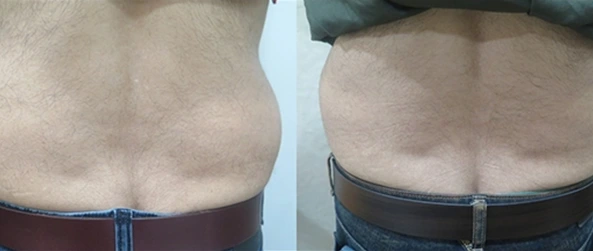 CoolSculpting Before & After