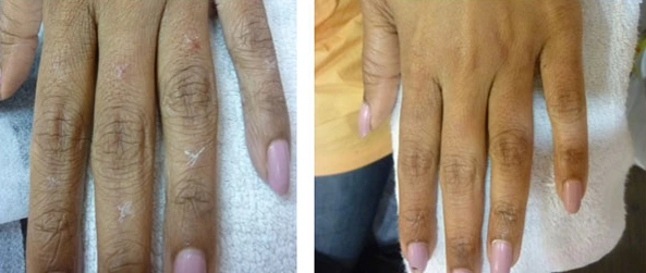 Filler Treatment Before & After