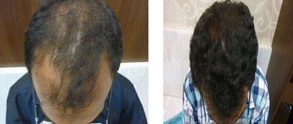 Hair Transplant Before & After