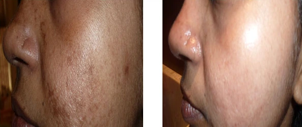 Pigmentation Treatment Before & After