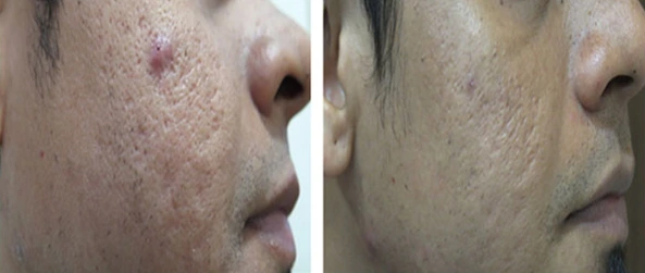 Scar Treatment Before & After
