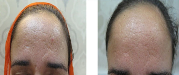 Scar Treatment Before & After
